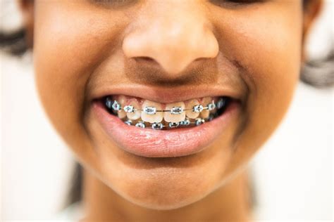 braces braces sydney ortho  parramatta canterbury