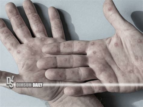 declares mpox  global health emergency