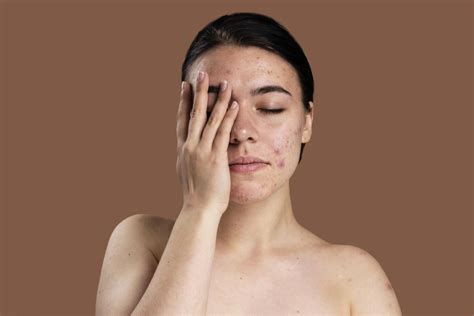 Keratin plug vs sebum plug | Are They Matter Of Concerns