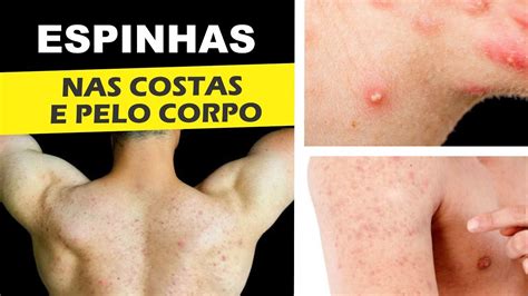 Espinhas Por Todo O Corpo - Como ACABAR COM AS ESPINHAS nas costas e no corpo - YouTube