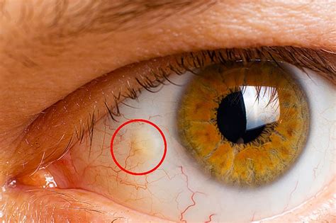 bump   eye types  growths  treatments