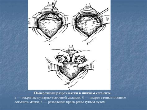 Показания к плановому кесареву сечению во время беременности ...