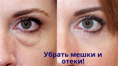 Мешки под глазами, синяки и отеки глаз! Вместо дорогой косметики от ...