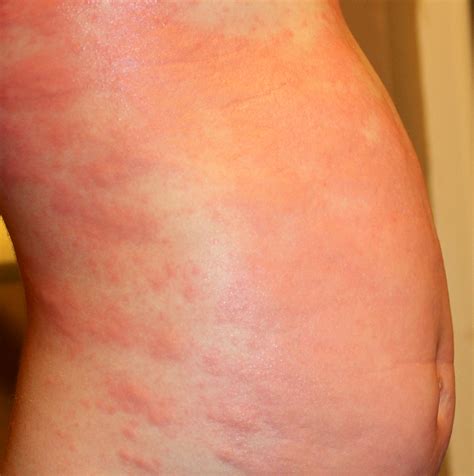 Urticaria Hives In Children Symptoms Rash Causes Treatment Images