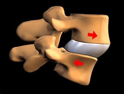 Cervical Subluxation treatment - jualitapomsiblog