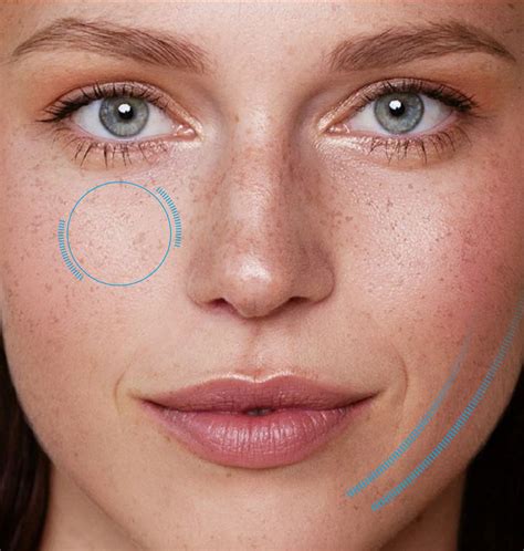 Endolift (non-surgical facelift) - Non-surgical Procedures - AA ENT ...