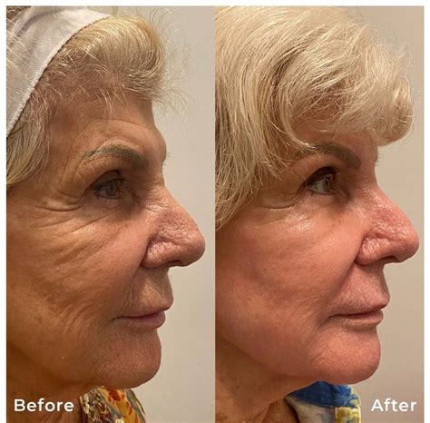 Renew Youthfulness Through CO2 Laser Treatments
