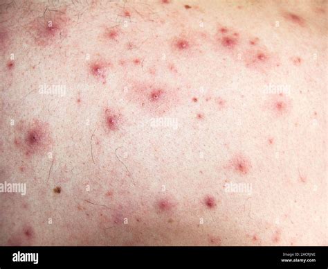 Acne pustules. Close-up of a man's upper back and shoulder area ...