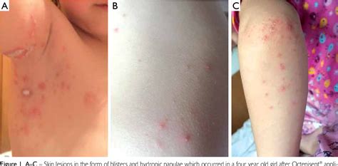 [PDF] Bullous skin lesion reaction as an example of an adverse effect ...