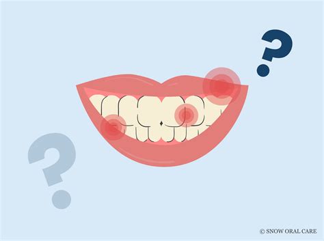 Does Teeth Whitening Hurt? Insider Tips!