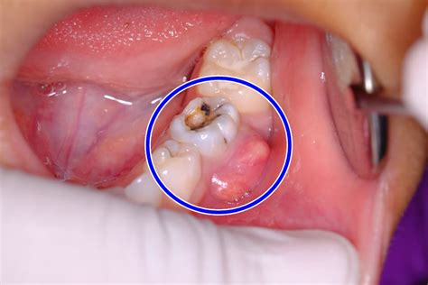 Tooth Abscess: Symptoms, Causes, and Treatment | ILAJAK Medical