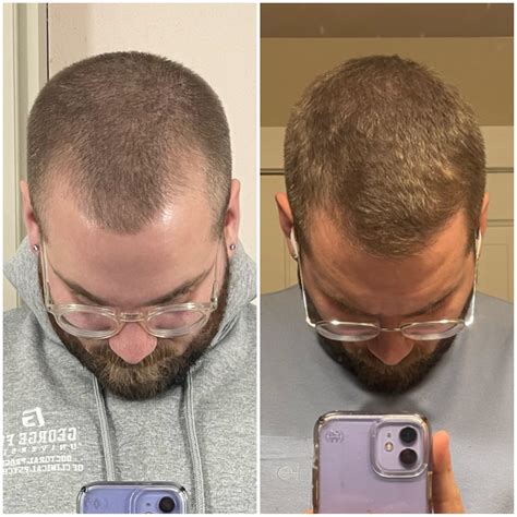 Souirensu It Works: My Results After [Number] Months! - hkasm19