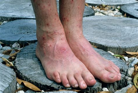 Understanding Chigger Bites: Prevention and Treatment