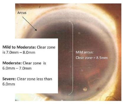 slit lamp evaluation  cornea pptx eye  vision conditions