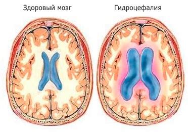 Повышенное внутричерепное давление: симптомы, лечение