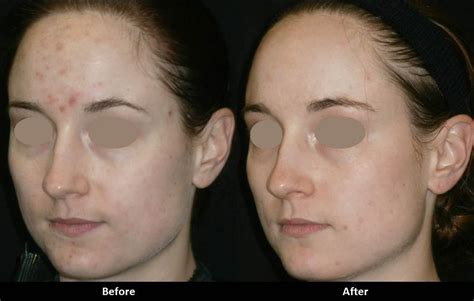 Clindoxyl Gel Antes E Depois - Clindoxyl Control Antes E Depois - RETOEDU