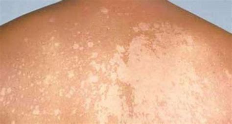 أعراض وأسباب مرض التينيا - العربي بوست