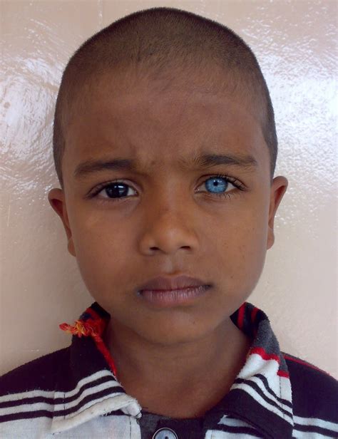 Dr. Mohammad Amir, MBBS, MS, MCh. (Neurosurgery): Hetrochromia Iridis