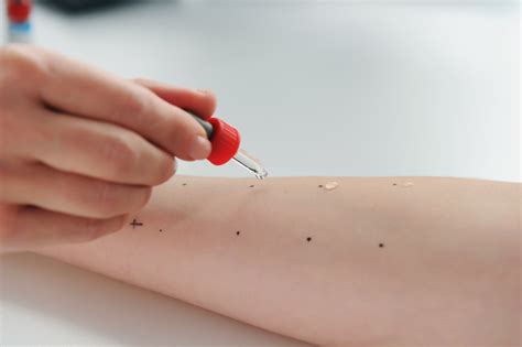 Alergološko testiranje - Dermatološki, laserski in estetski center ...