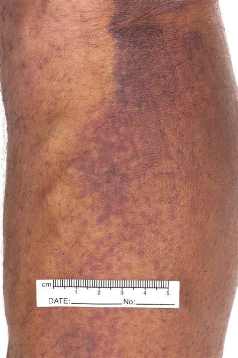 Petechiae On Shins