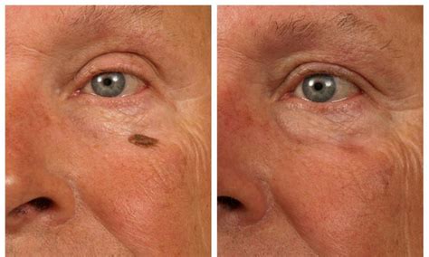 Mole & Lesion Removal for Clearer, Healthier Skin