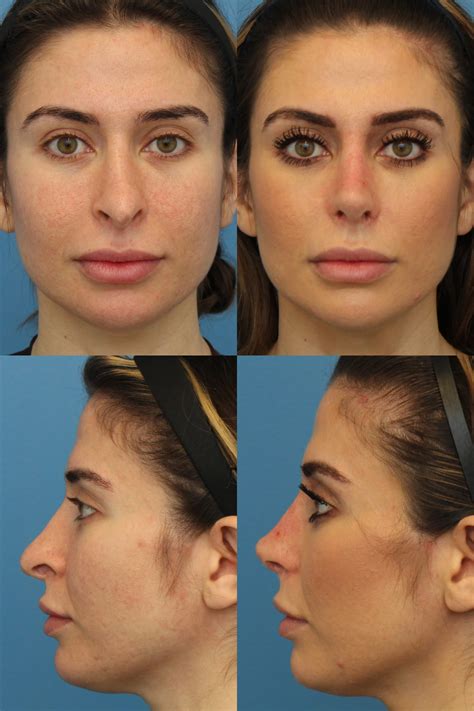 Before & After Photos | Ranch & Coast Plastic Surgery & Med Spa