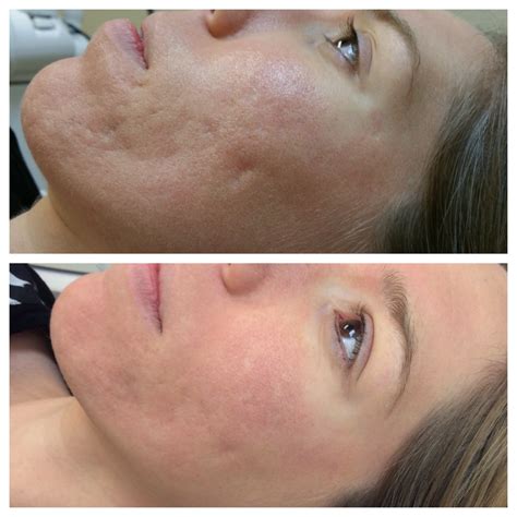 Nonablative Laser Scars Order Online | dpise2022.dps.uminho.pt