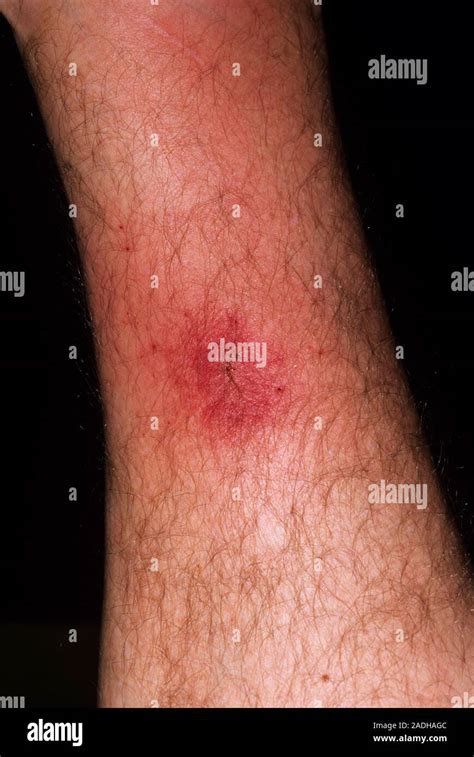 cellulitis    year  womans leg  week   insect bite