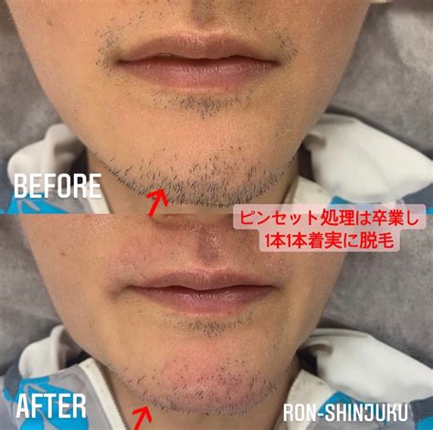 男髭抜く, 髭 抜く 気持ちいい – 【徹底解説】ヒゲの埋没毛の原因と治す方法 – VROM