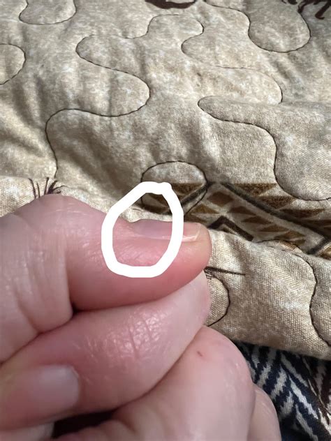 Nail bumps? What is this? : r/medical