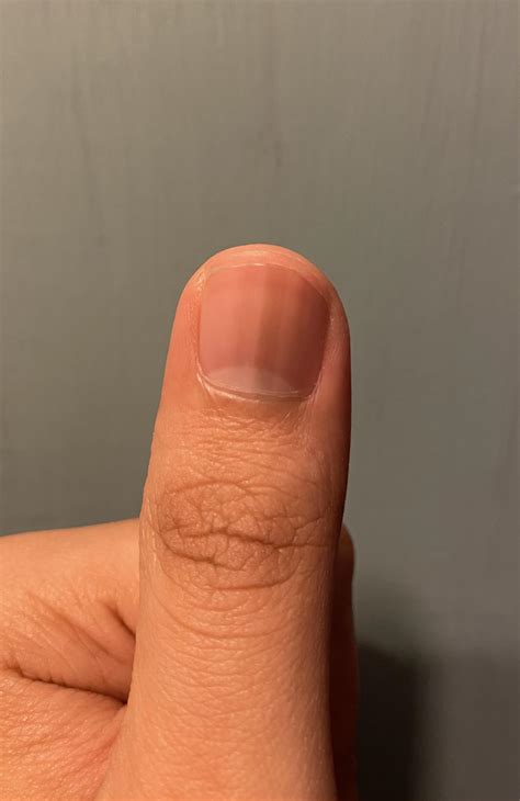 I have this light black line on my left thumb! Been few months! Anyone