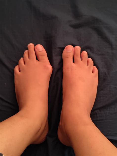 138 best r/bunions images on Pholder | 16 days post op
