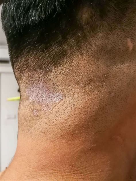 Tinea Capitis: Symptoms and Treatment | Dr. Serkan Aygin
