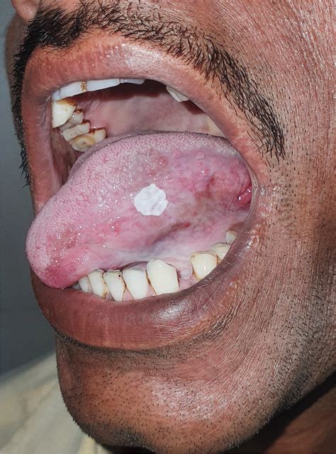 White Tongue