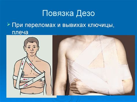 Как наложить повязку дезо пошагово: Алгоритм 15 Повязка Дезо