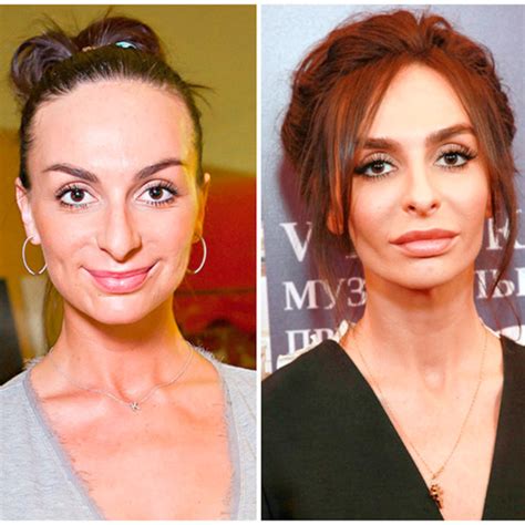 Захия дехар до пластики фото до и после