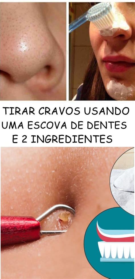 Cravos E Espinhas Como Tirar - Dicas Caseiras Para Eliminar Cravos e Espinhas Rapidamente! | Skin care ...