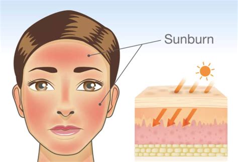 Best Way to Reduce Sun Rash. Sunburn is a type of skin damage that ...