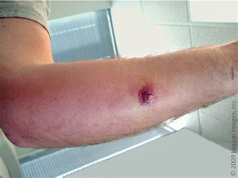 MRSA a communitywide problem, study finds | Article | The United States ...