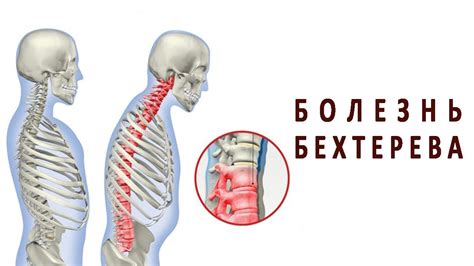 Спондилоартрит: лечение, диагностика, симптомы и гимнастика