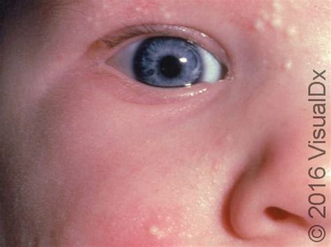 white bumps  cheeks kids