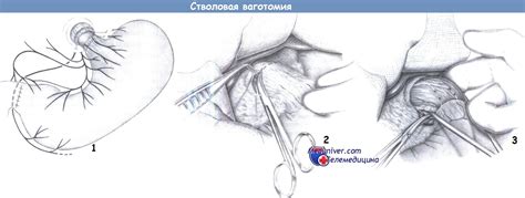 Этапы и техника стволовой ваготомии
