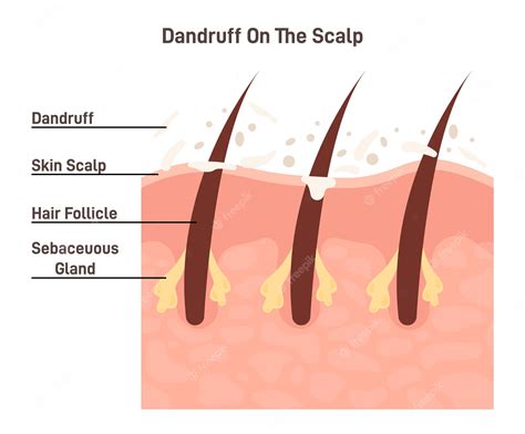 Dry Scalp Flakes