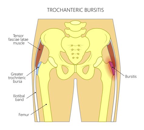 Hip (Trochanteric) Bursitis/ Tendinitis | CHARM