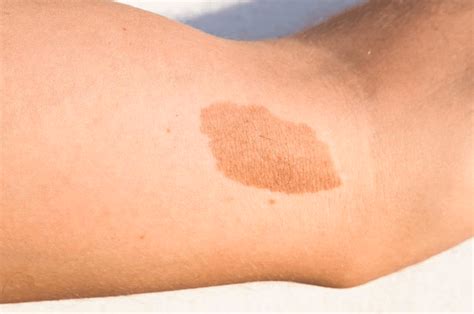 Mancha De Nascença Marrom Claro - Nevus Congênito - Como Tratar Uma Marca de Nascença