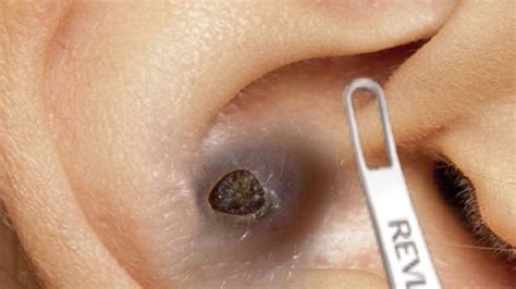 Forget Everything You Know: This is Unbelievable Blackhead Removal 2024 - arg5gsy