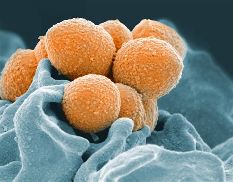 uk hospitals  reporting  rise  severe strep cases poynter