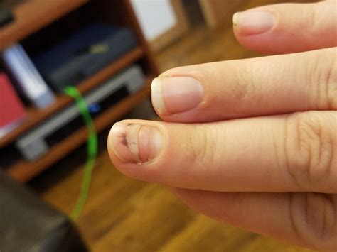 Wife bruised nail has decided to cut it's losses and start from scratch