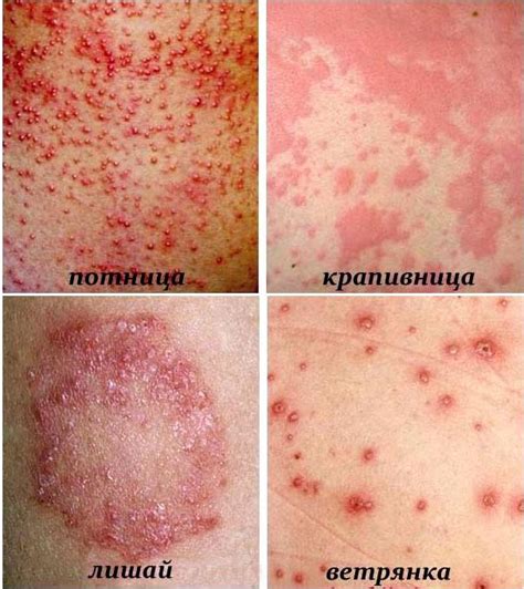 Почему На Теле Красные Пятна Фото — Bluemorphotours.ru