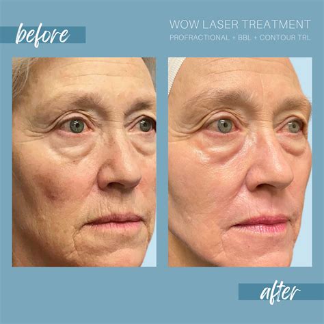 Laser Resurfacing Denver | Skin Resurfacing Denver
